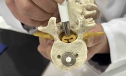 Beldeki gizli tehlike: Spinal stenoz