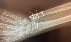 Karakoçan Devlet Hastanesi'nde ortopedi ameliyatları başladı