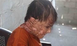 Gazze'de nadir cilt hastalığıyla mücadele eden genç kız: 'İyileşip elbise giymenin hayalini kuruyorum'