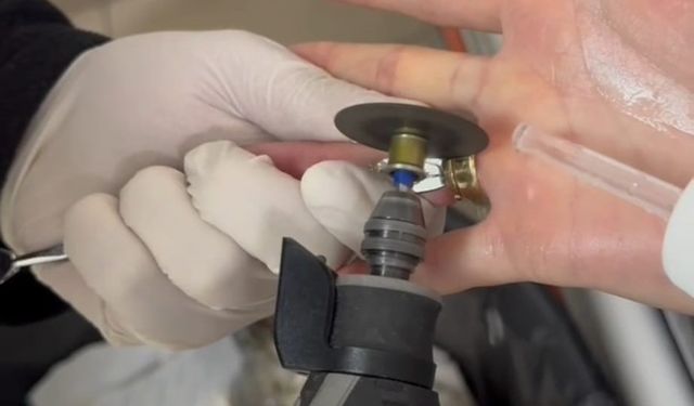 Batman'da parmağa sıkışan iki yüzük 'spiral makine' ile çıkarıldı