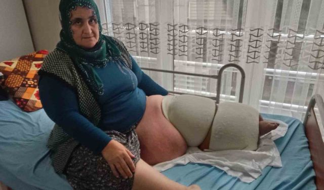 Fil hastalığı bacağını 100 kilo yaptı, tedavisinin devamı için destek bekliyor