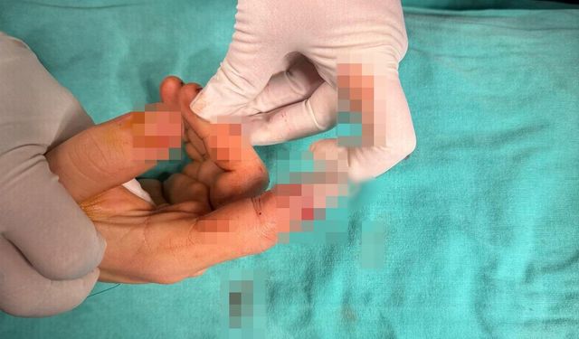 Bandırma'da asansör kazasında kopan parmak başarılı ameliyatla kurtarıldı