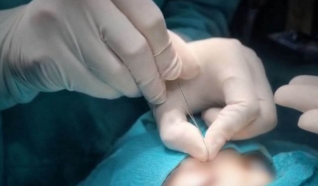 Çukurca'da gözyaşı kanalı ameliyatları yapılmaya başlandı