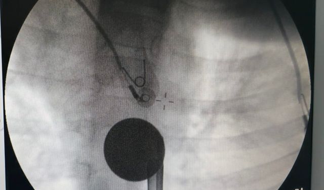 Siirt'te boğazına madeni para kaçan çocuk, doktorların müdahalesi ile kurtarıldı