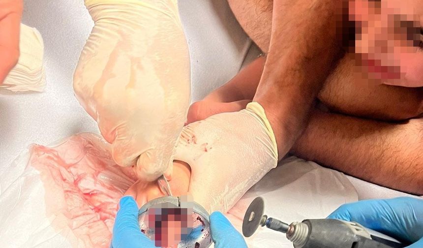 Bursa’da çocuğun parmağı çeşme aynasına sıkıştı